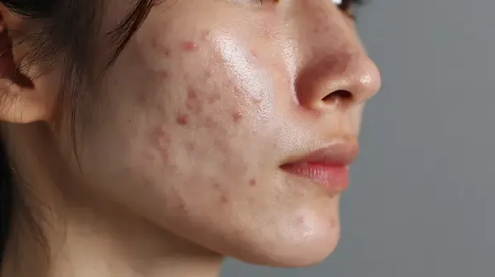 Acne vulgaris
